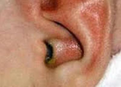 چگونه عفونت گوش را درمان کنیم